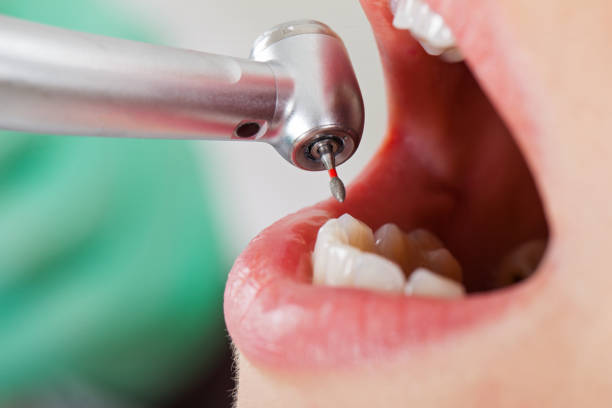 Best Emergency Treatment for Dental Infections or Abscesses in Clinton, NY